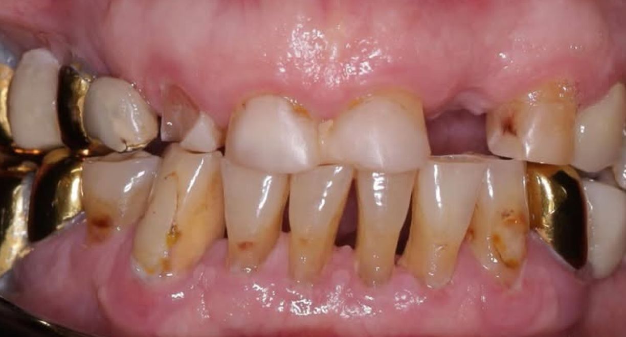 Alllon4 -2 before