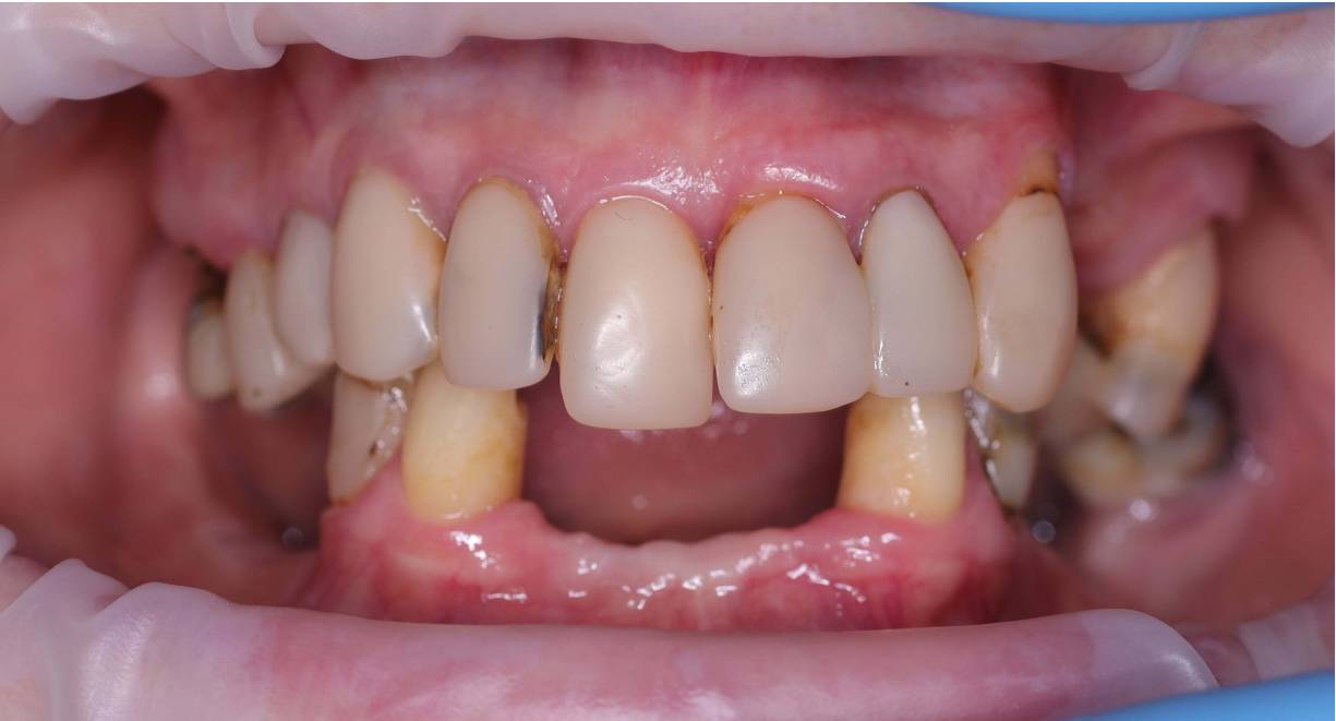 Allon4 -3 before