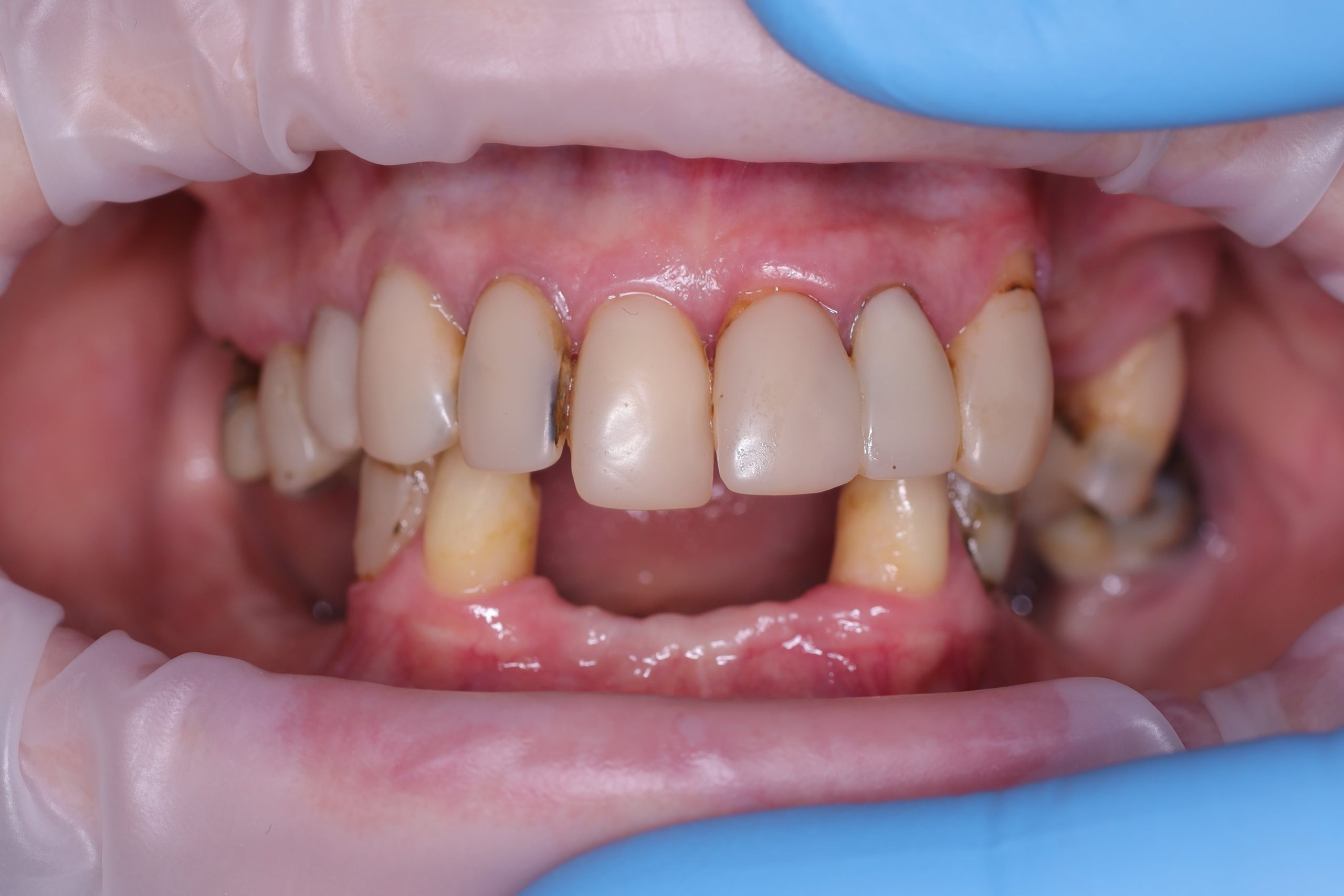 Allon4 -3 before