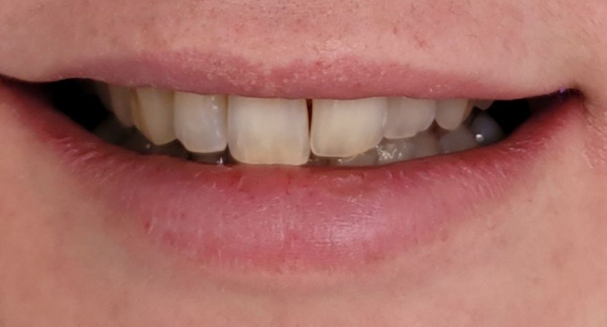 Vinirai -10 before