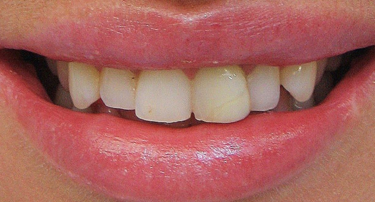 Vinirai -13 before