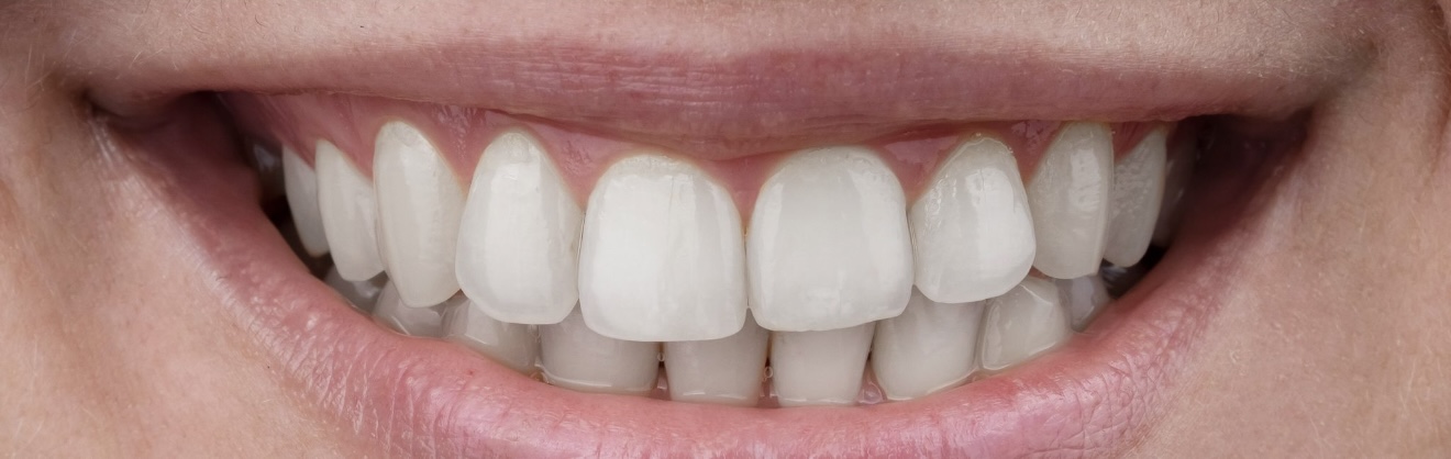 White3 after