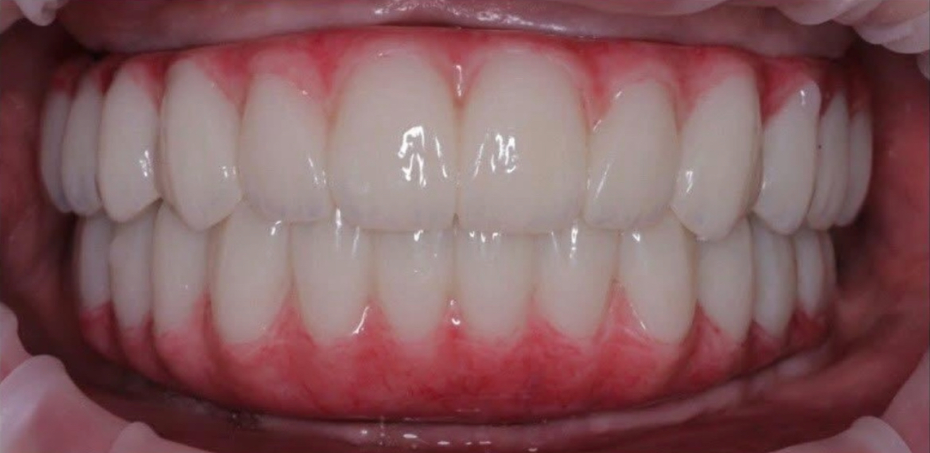 4I-1 after