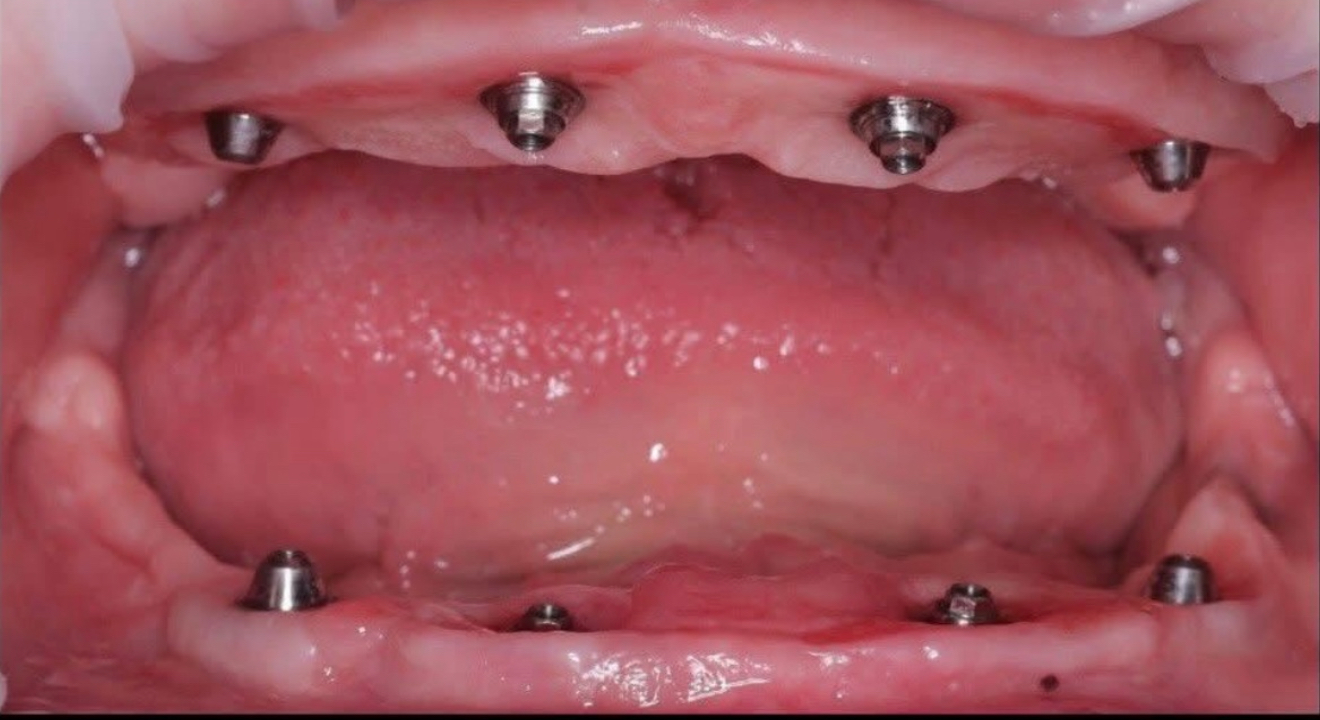 4I-1 before